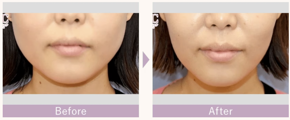 ボトックス おすすめ